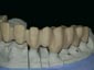 Full arch in zirconio calzato sul master